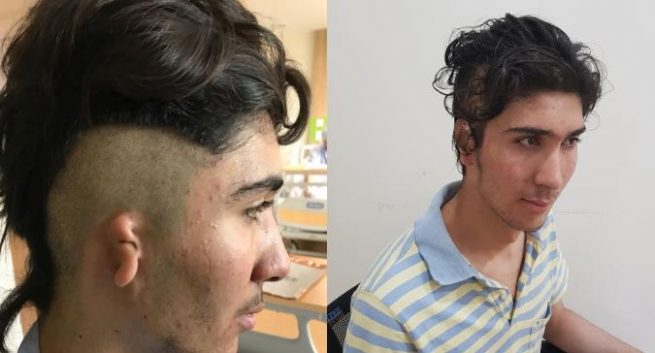 Doctors at Jaypee Hospital successfully reconstructed the ear of an Afghanistani national